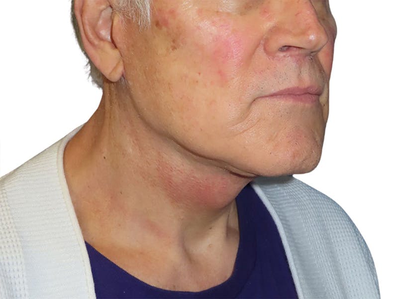Facelift Before & After Gallery - Patient 134387 - Image 2