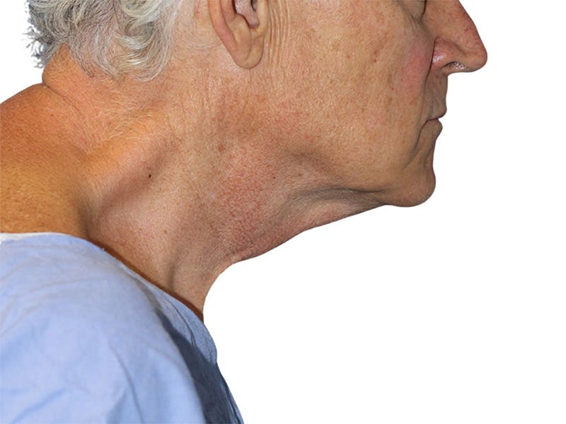 Facelift Before & After Gallery - Patient 134387 - Image 3