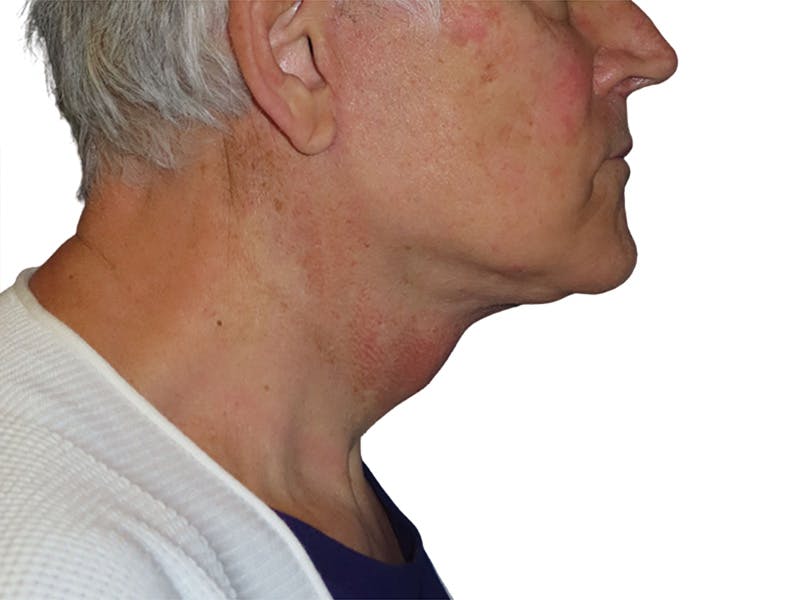 Facelift Before & After Gallery - Patient 134387 - Image 4