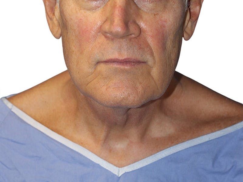 Facelift Before & After Gallery - Patient 134387 - Image 5