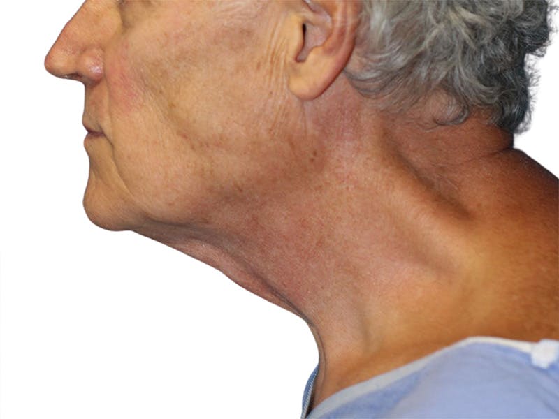 Facelift Before & After Gallery - Patient 134387 - Image 7