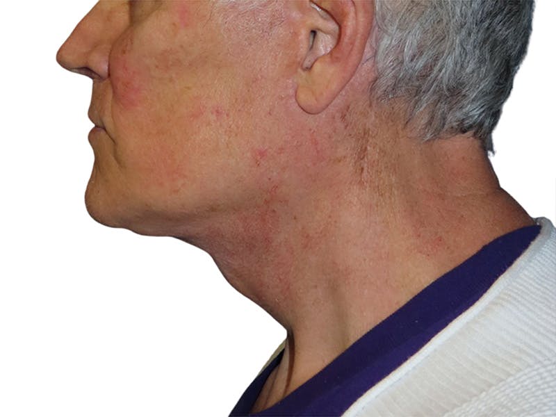 Facelift Before & After Gallery - Patient 134387 - Image 8
