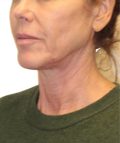 Facelift Before & After Gallery - Patient 346459 - Image 1