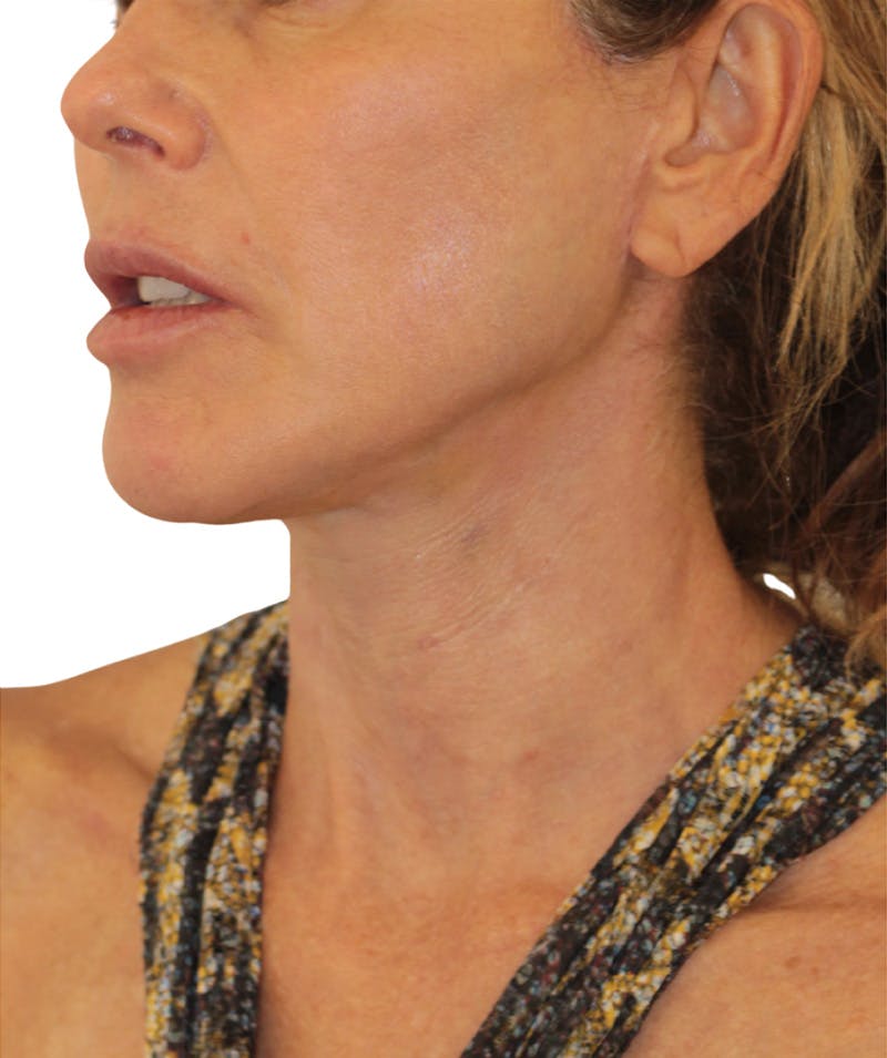 Facelift Before & After Gallery - Patient 346459 - Image 2