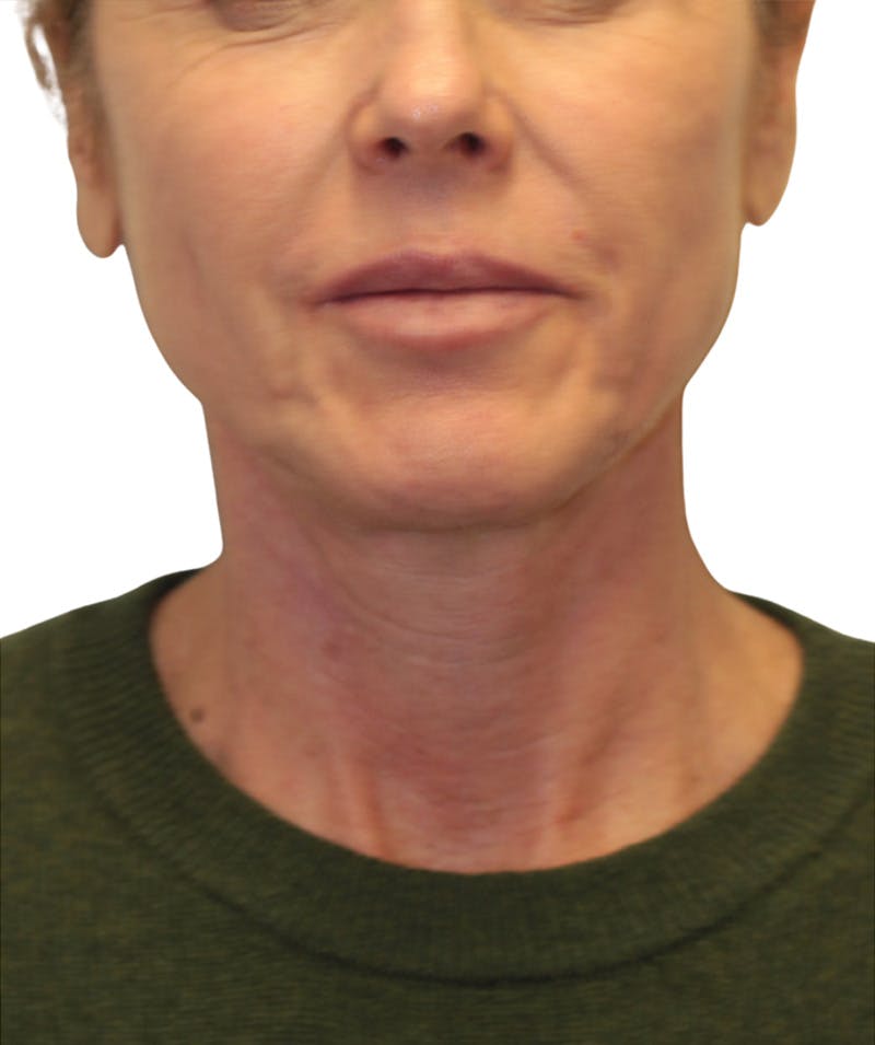 Facelift Before & After Gallery - Patient 346459 - Image 3