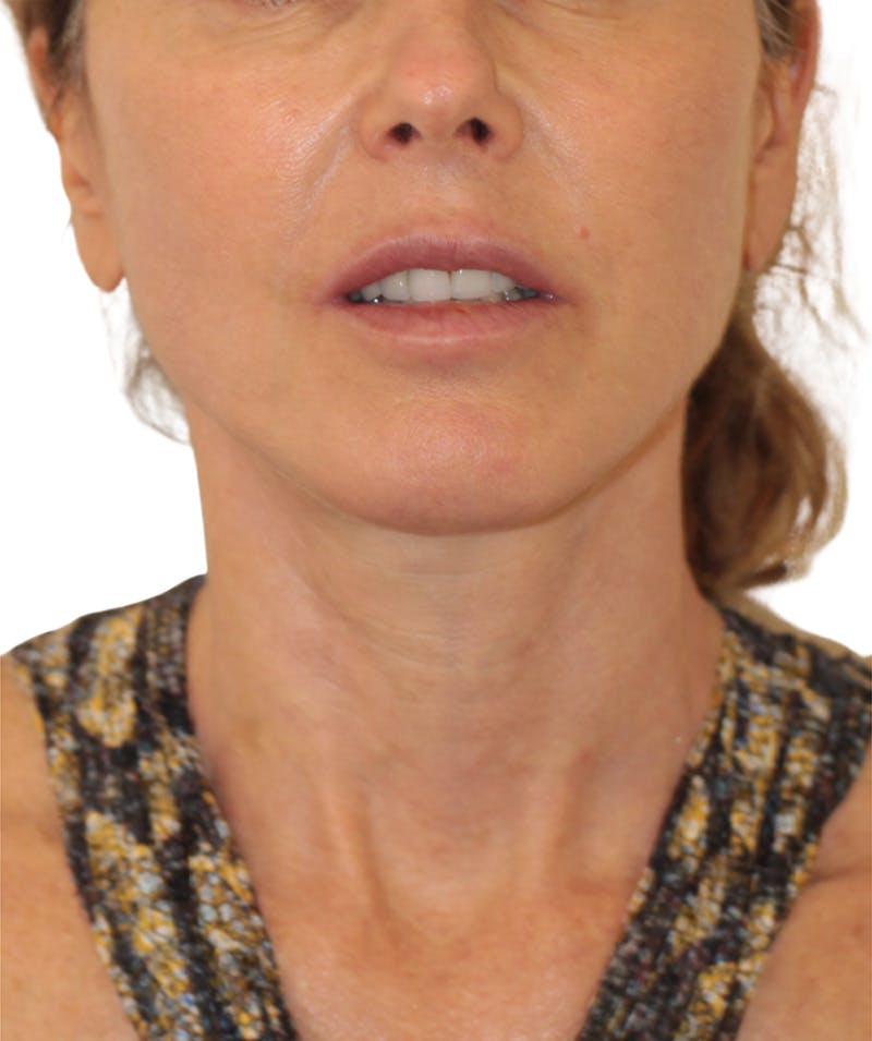 Facelift Before & After Gallery - Patient 346459 - Image 4