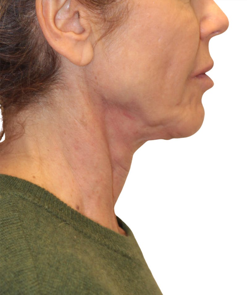Facelift Before & After Gallery - Patient 346459 - Image 5