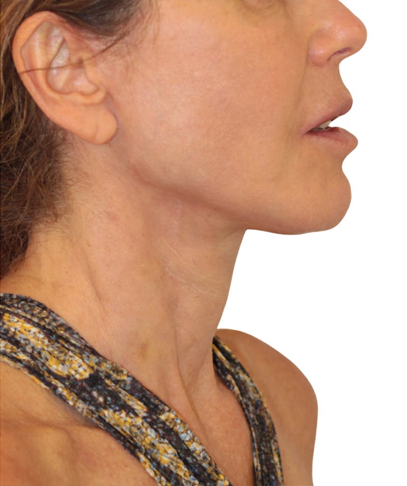 Facelift Before & After Gallery - Patient 346459 - Image 6