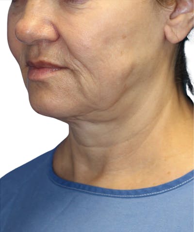 Facelift Before & After Gallery - Patient 322758 - Image 1