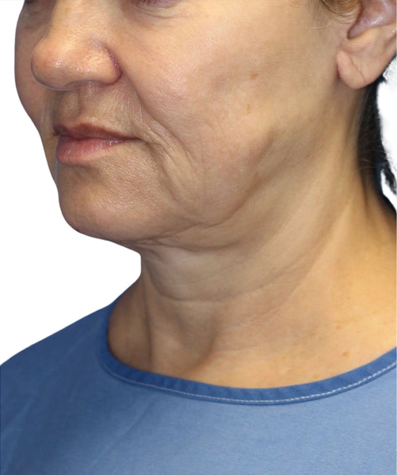 Facelift Before & After Gallery - Patient 322758 - Image 1