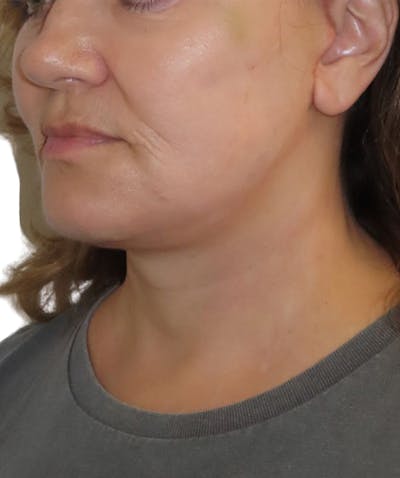 Facelift Before & After Gallery - Patient 322758 - Image 2