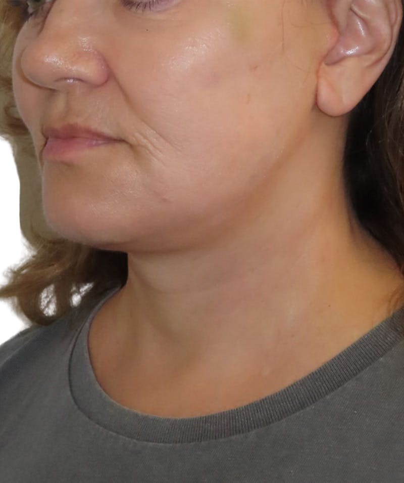 Facelift Before & After Gallery - Patient 322758 - Image 2