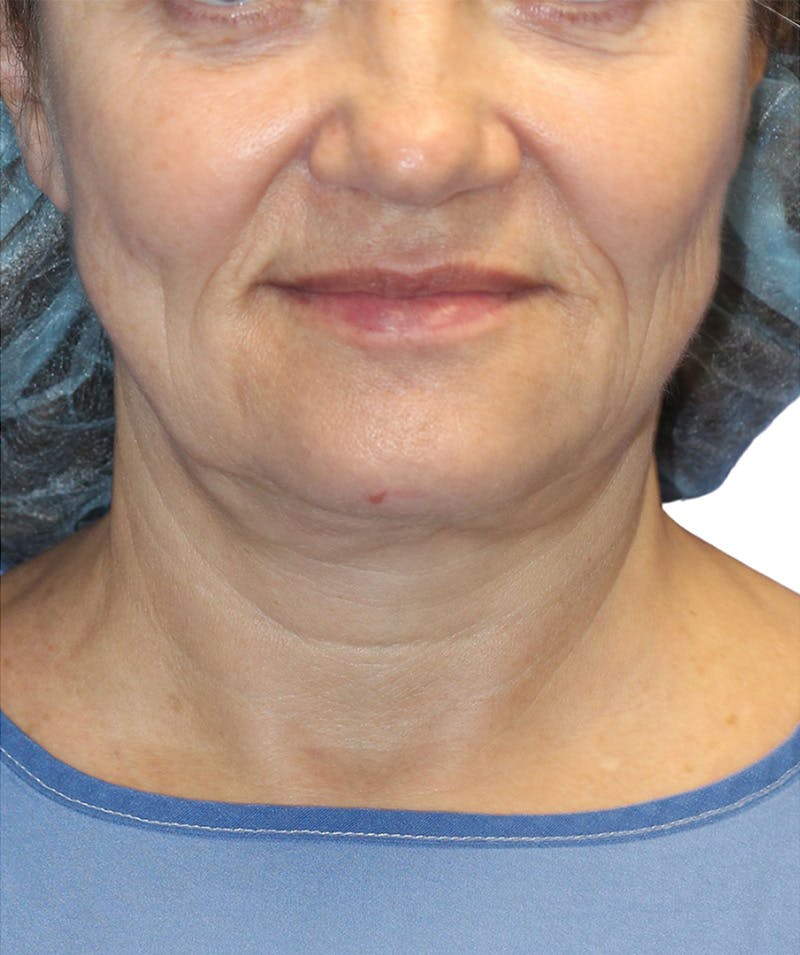 Facelift Before & After Gallery - Patient 322758 - Image 3