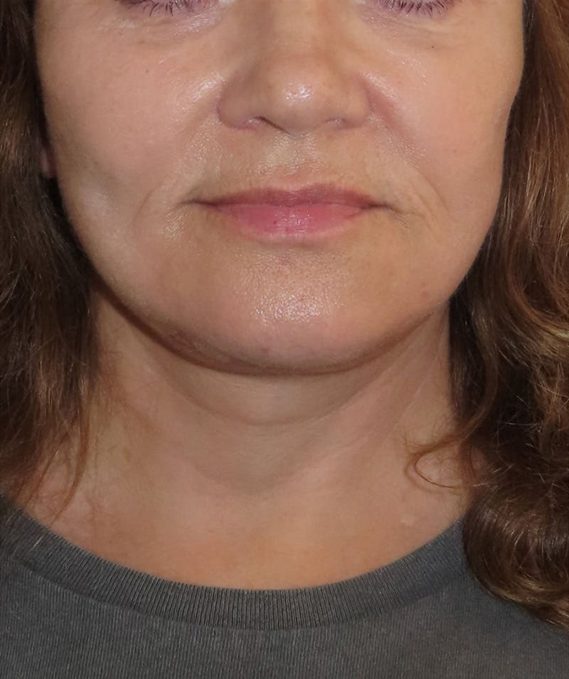 Facelift Before & After Gallery - Patient 322758 - Image 4