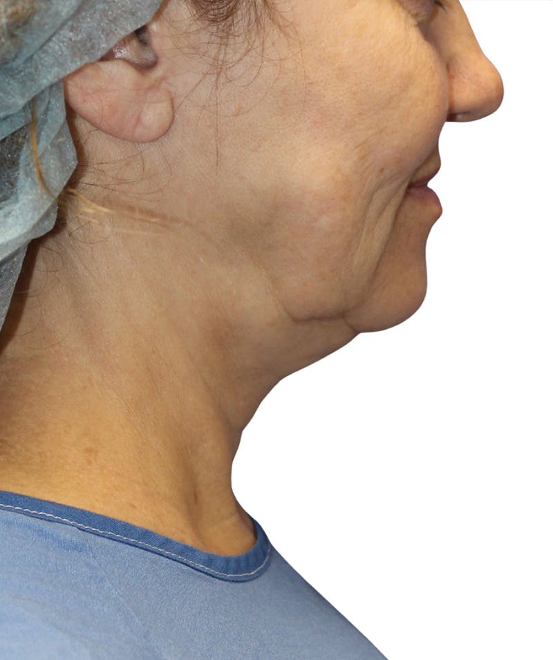 Facelift Before & After Gallery - Patient 322758 - Image 5