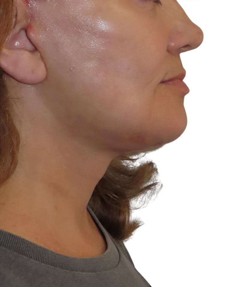 Facelift Before & After Gallery - Patient 322758 - Image 6