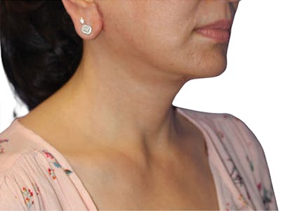 Facelift Before & After Gallery - Patient 415825 - Image 2