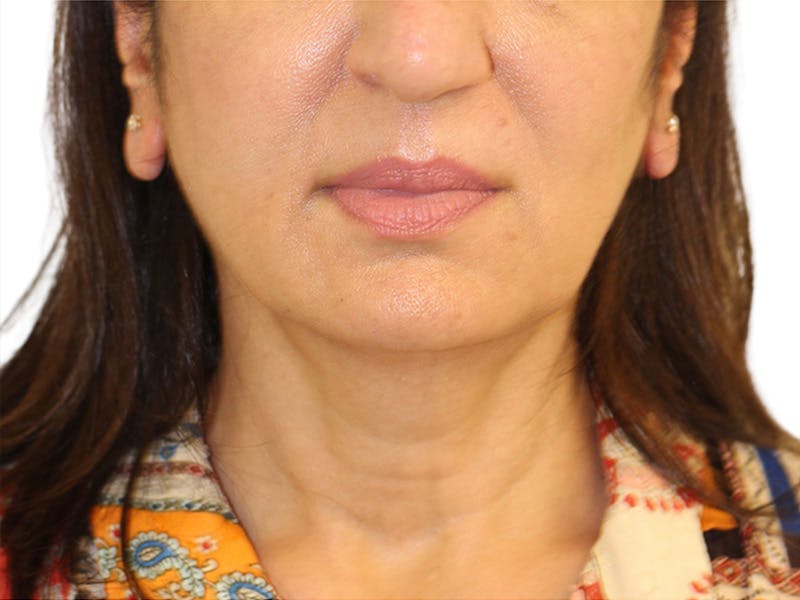 Facelift Before & After Gallery - Patient 415825 - Image 3