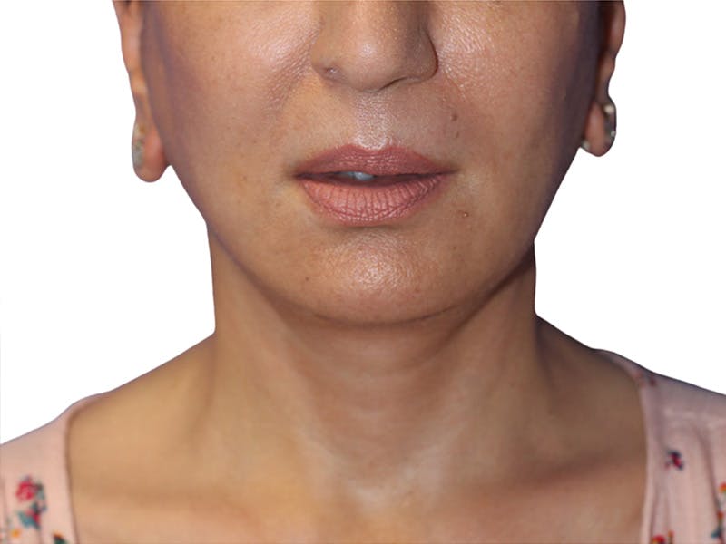Facelift Before & After Gallery - Patient 415825 - Image 4