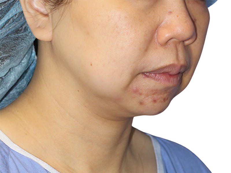 Facelift Before & After Gallery - Patient 104397 - Image 1