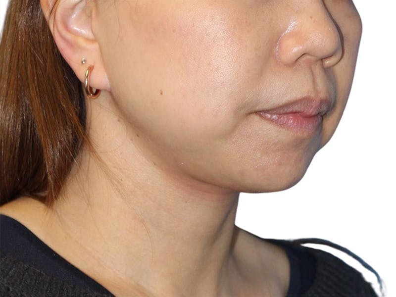 Facelift Before & After Gallery - Patient 104397 - Image 2