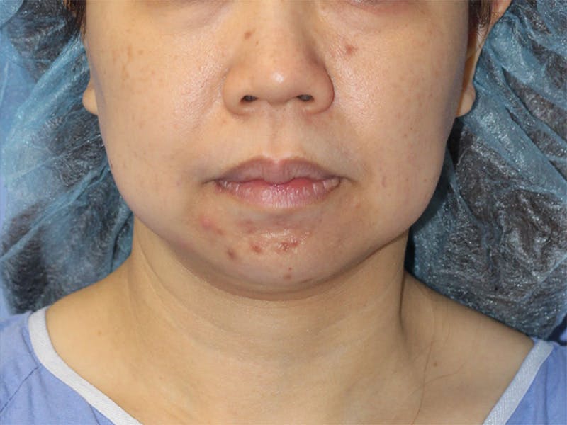 Facelift Before & After Gallery - Patient 104397 - Image 3