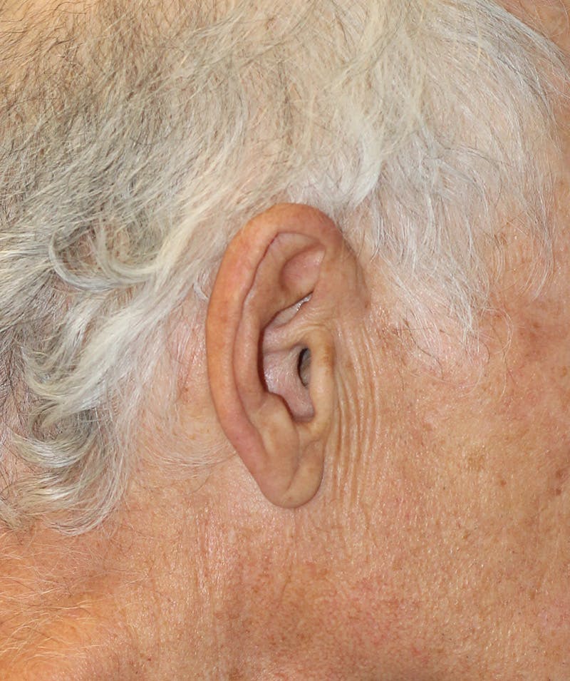 Facelift Before & After Gallery - Patient 407848 - Image 1