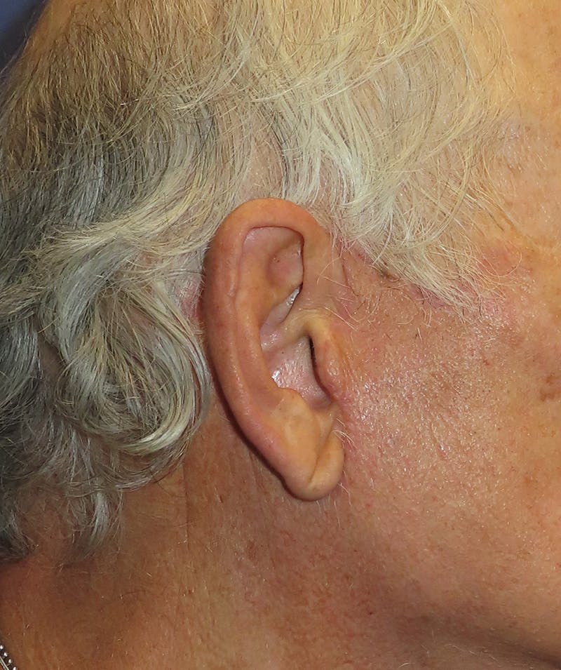 Facelift Before & After Gallery - Patient 407848 - Image 2