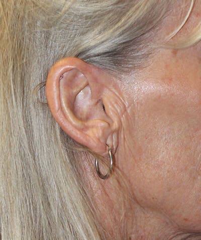 Facelift Before & After Gallery - Patient 311919 - Image 1