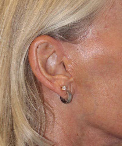 Facelift Before & After Gallery - Patient 311919 - Image 2