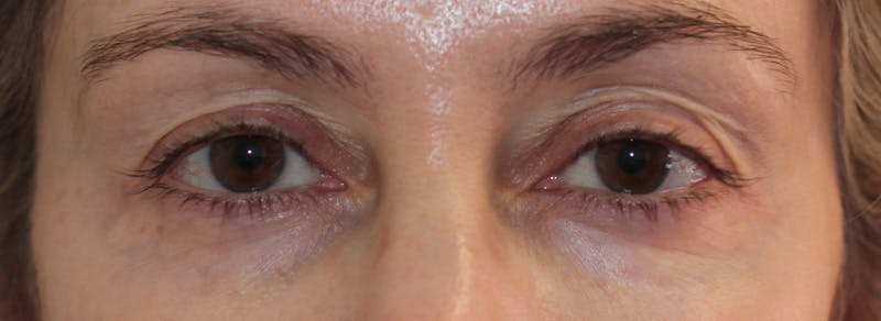 Blepharoplasty Before & After Gallery - Patient 217505 - Image 1