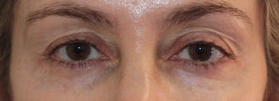 Blepharoplasty Before & After Gallery - Patient 217505 - Image 1