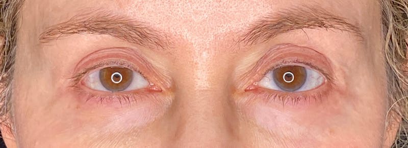 Blepharoplasty Before & After Gallery - Patient 217505 - Image 2