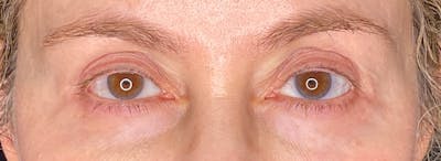 Blepharoplasty Before & After Gallery - Patient 217505 - Image 2