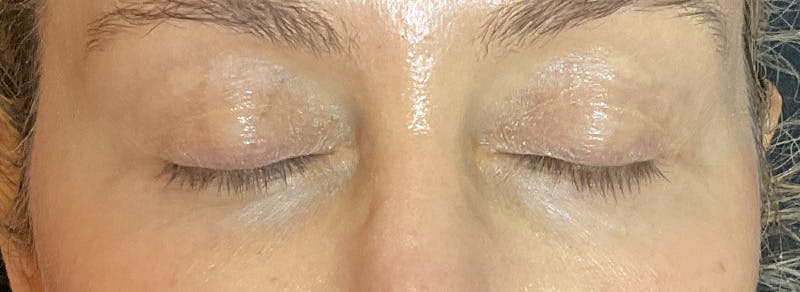 Blepharoplasty Before & After Gallery - Patient 217505 - Image 3