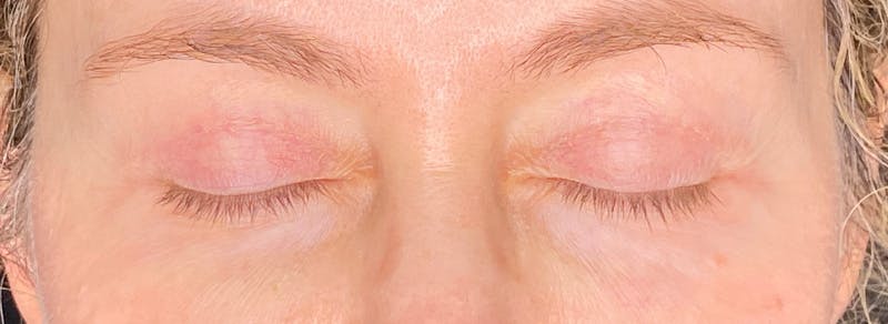 Blepharoplasty Before & After Gallery - Patient 217505 - Image 4
