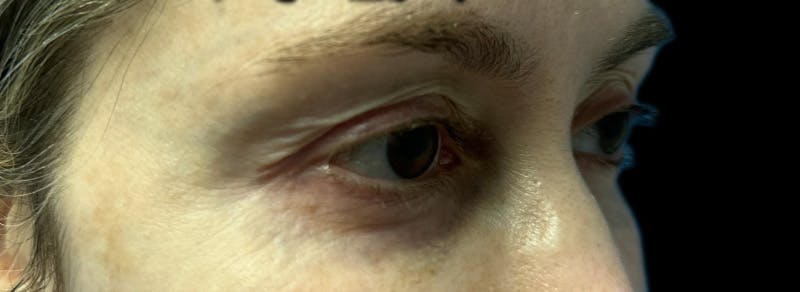 Blepharoplasty Before & After Gallery - Patient 217505 - Image 5