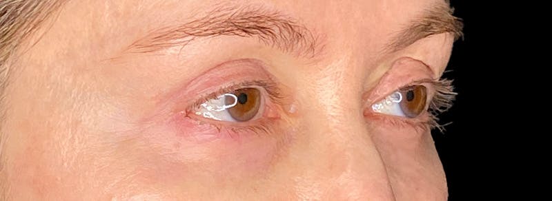 Blepharoplasty Before & After Gallery - Patient 217505 - Image 6