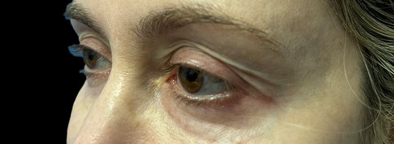 Blepharoplasty Before & After Gallery - Patient 217505 - Image 7