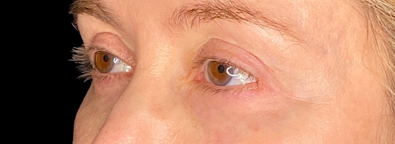 Blepharoplasty Before & After Gallery - Patient 217505 - Image 8