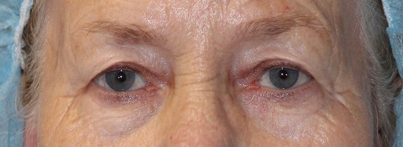 Blepharoplasty Before & After Gallery - Patient 283878 - Image 1