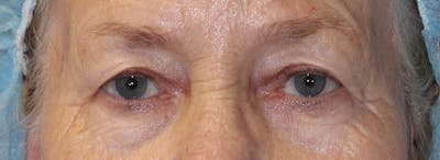 Blepharoplasty Before & After Gallery - Patient 283878 - Image 1