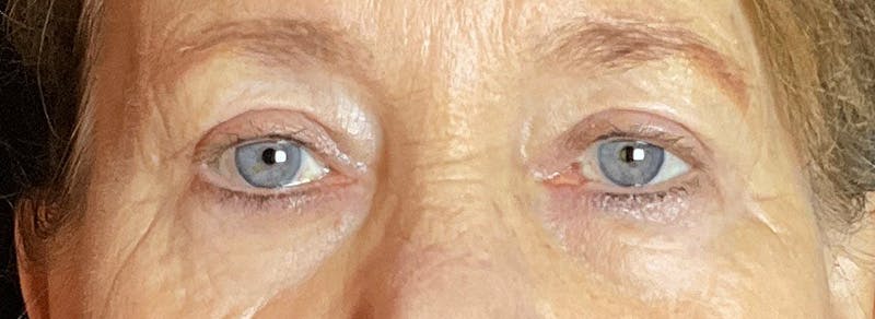 Blepharoplasty Before & After Gallery - Patient 283878 - Image 2