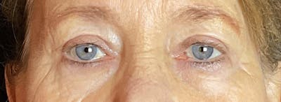 Blepharoplasty Before & After Gallery - Patient 283878 - Image 2