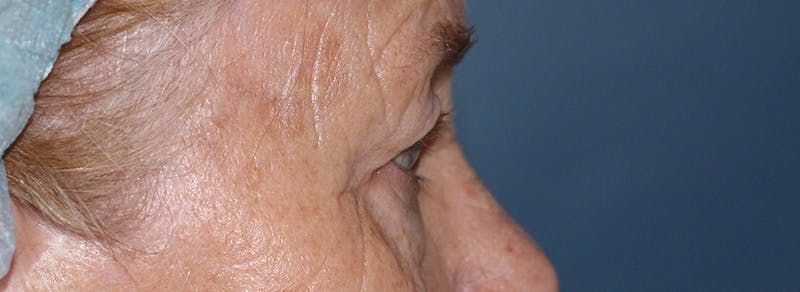 Blepharoplasty Before & After Gallery - Patient 283878 - Image 3