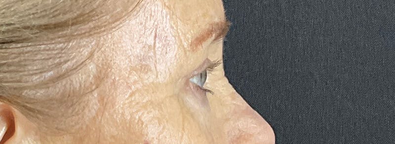 Blepharoplasty Before & After Gallery - Patient 283878 - Image 4