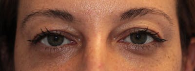Blepharoplasty Before & After Gallery - Patient 200908 - Image 1