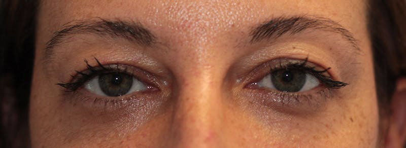 Blepharoplasty Before & After Gallery - Patient 200908 - Image 1