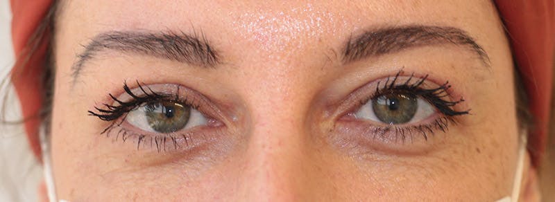 Blepharoplasty Before & After Gallery - Patient 200908 - Image 2
