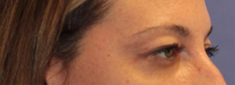 Blepharoplasty Before & After Gallery - Patient 200908 - Image 3